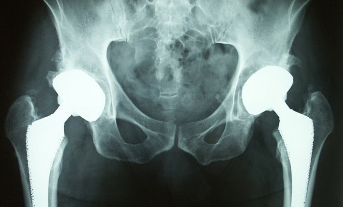 Protesi all’anca