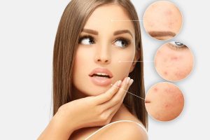 Rimedi naturali per contrastare le cicatrici
